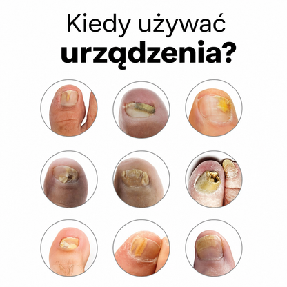 Zdrowa Stopa™ Laserowa Regeneracja Paznokci